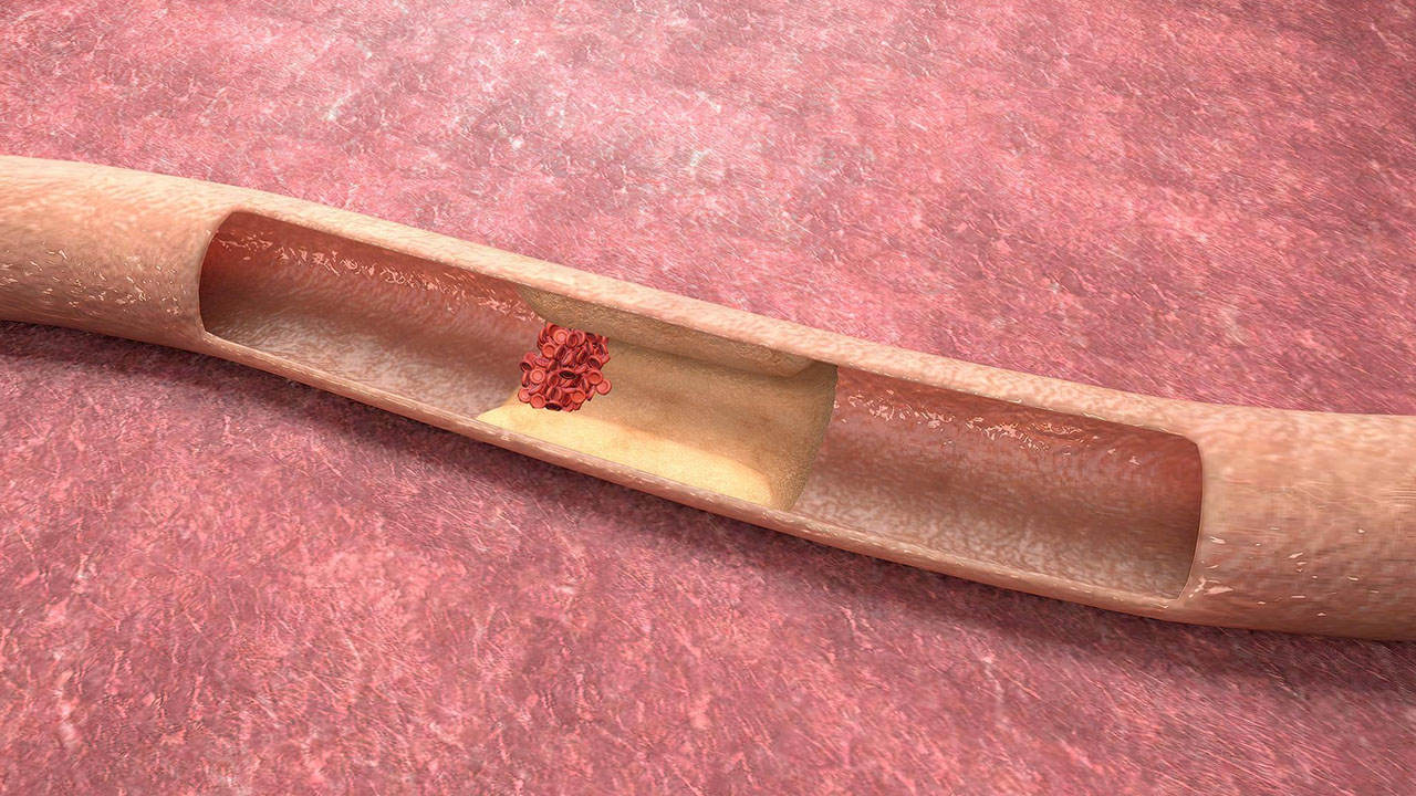 Peripheral Angioplasty